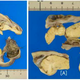 Imagen del teratoma encontrado en la joven. Foto: Masayuki Shintaku